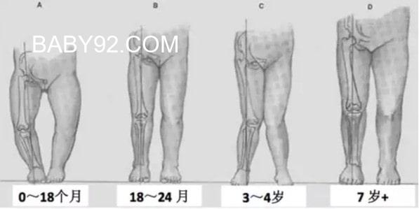 两岁多宝宝腿不直怎么办