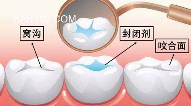 儿童牙齿窝沟封闭是什么意思