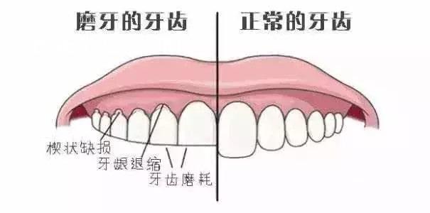 孩子晚上睡觉磨牙的危害