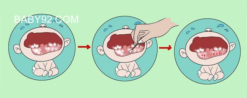 两个月婴儿鹅口疮最佳治疗方法
